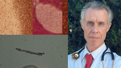 Doctor shows that when the Pfizer “vaccine” is added to blood - the blood loses oxygen and clots!