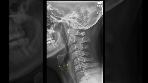 Testing cervical anatomy (X-rays) Part B #shorts