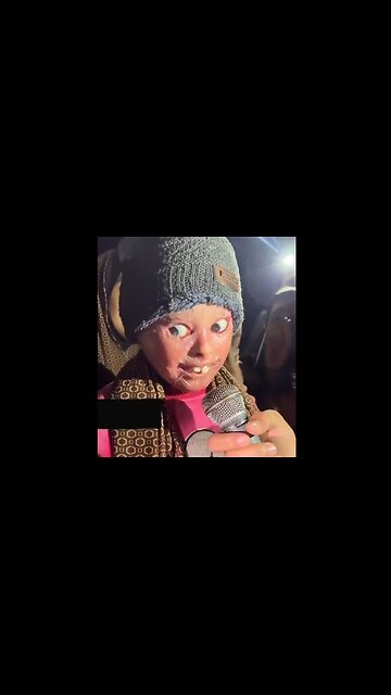 Effects of White Phosphorus Used by jEEWs on Palestinian Girl. She Lost Her Eyelids.