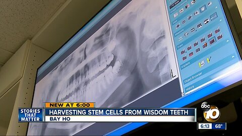 Harvesting stem cells from wisdom teeth