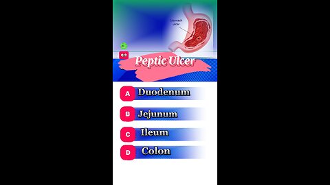 Peptic ulcer question answers mcqs #stomach #ulcer #disease #pepticulcer