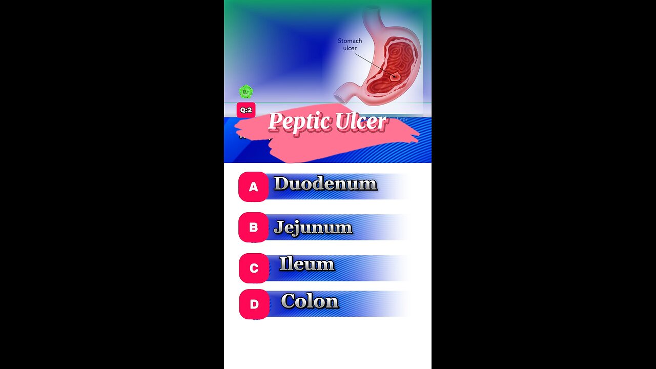 Peptic ulcer question answers mcqs #stomach #ulcer #disease #pepticulcer