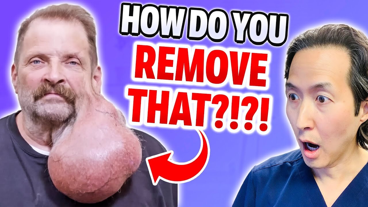 MASSIVE Face Growth Removal! EXTREME BODIES EXPLAINED!