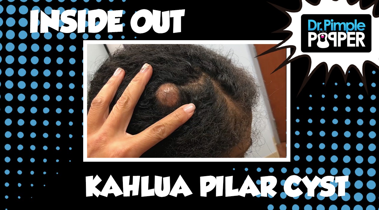 Inside Out Kahlua Pilar Cyst