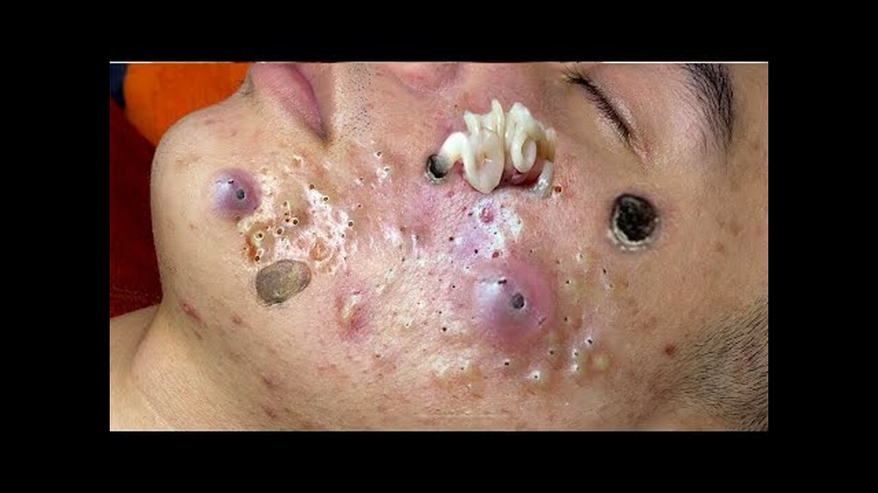 Blackheads Whiteheads Removal Dr Pimple Popper Cystic Acne Extraction 224