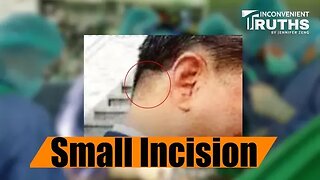 Another 'Rumor' Proven True: Did Xi Jinping Undergo Brain Surgery?