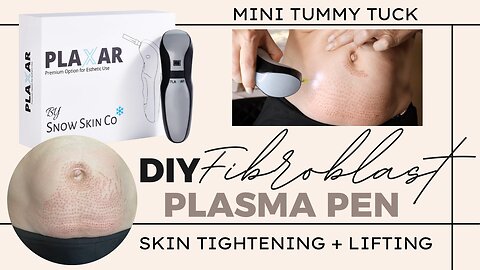 DIY Plasma Fibroblast on my stomach