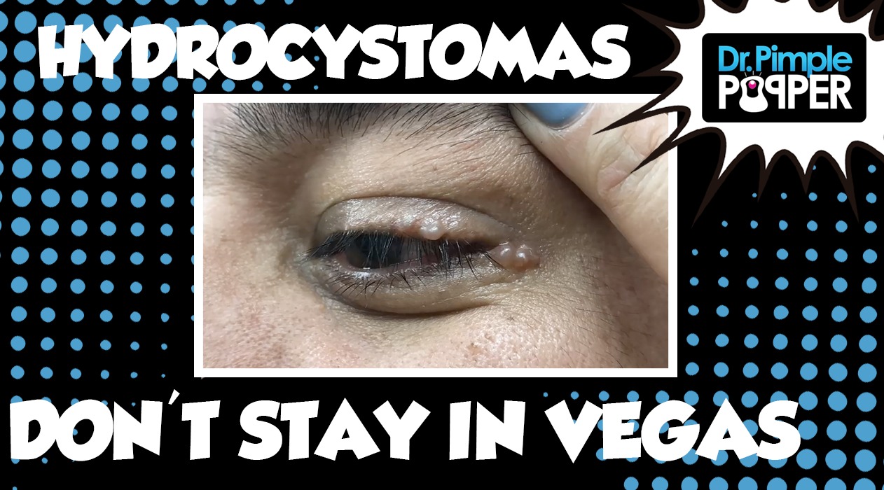 Hidrocystomas don't stay in Vegas