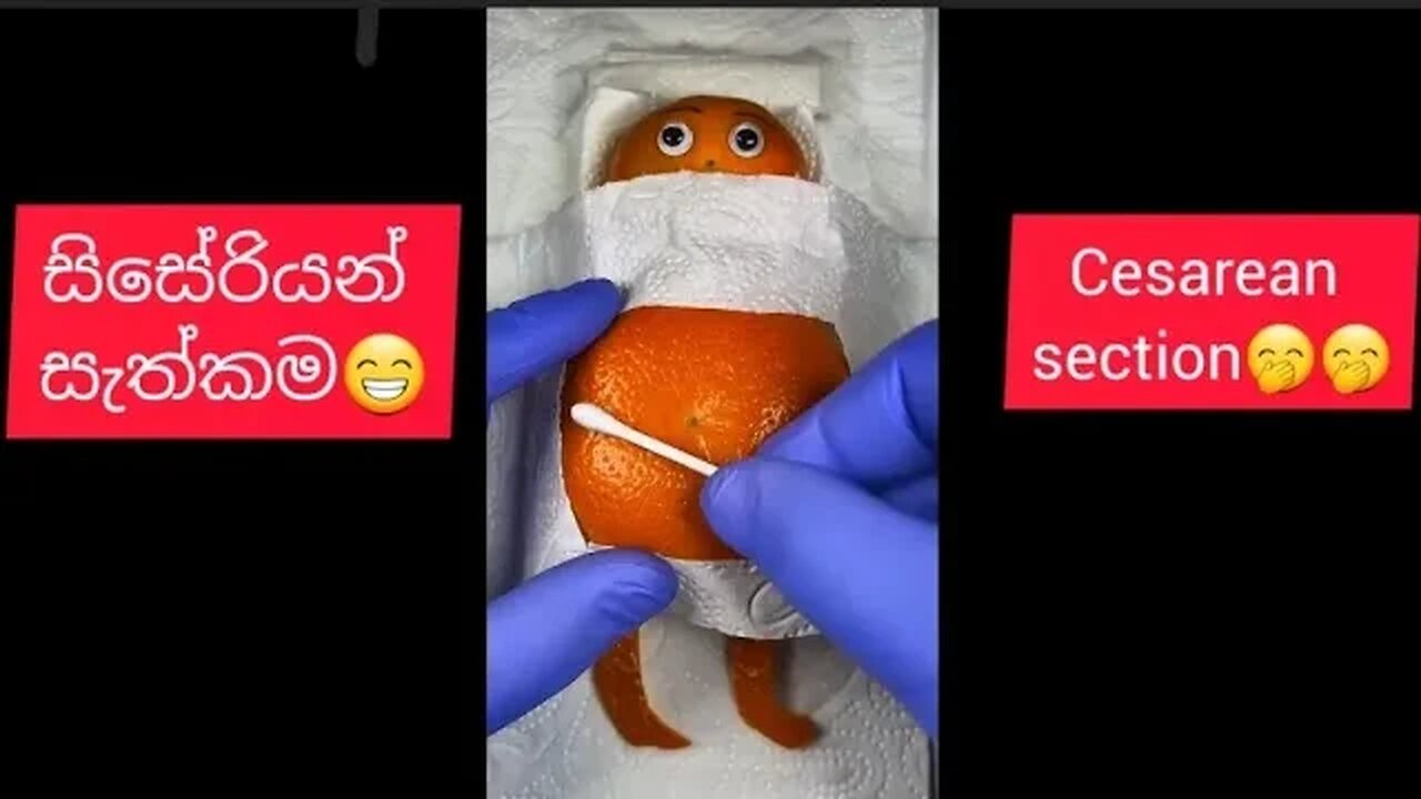 සිසේරියන් සැත්කම ගැන හරියටම දැන ගන්න.(Caesarean Section)#xxx