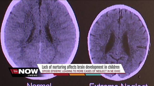 Opioid epidemic leads to more cases of neglect, causing less-developed brains in NE Ohio children