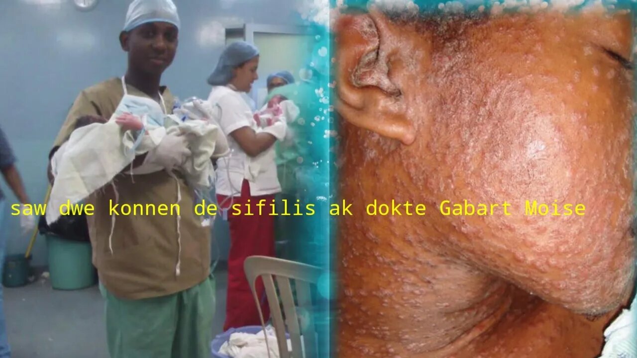 tout sa ou dwe konnen de std sifilis ak dokte Gabart Moise