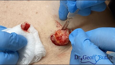 Removal of an Epidermal Cyst on the mid back