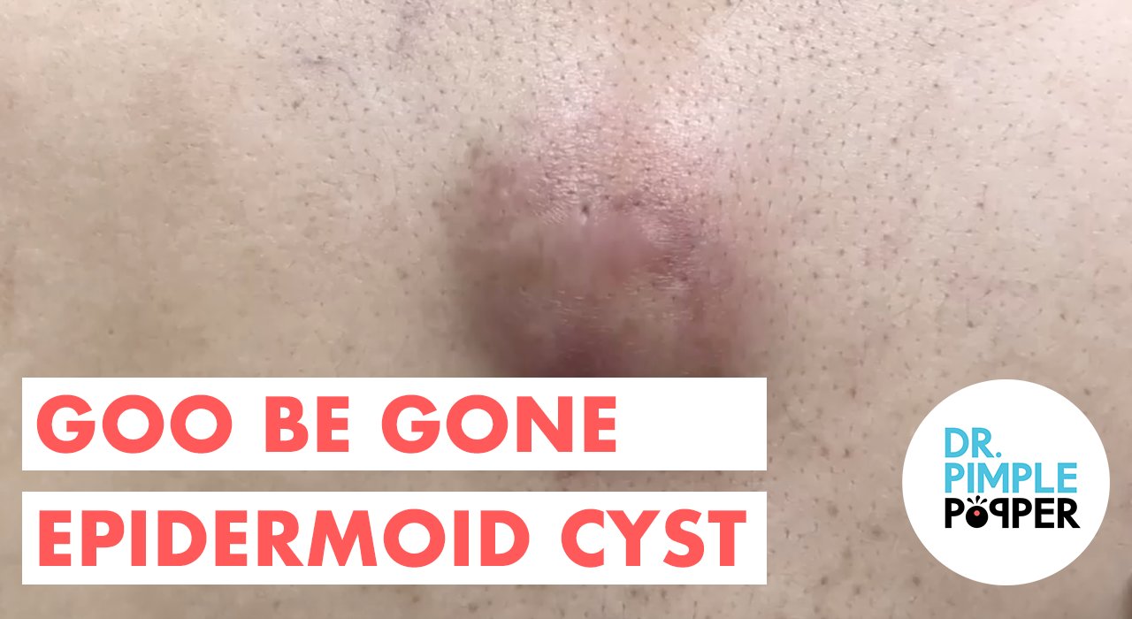 "Goo-Be-Gone" Cyst