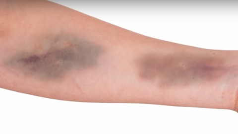 Do You Get Bruises Easily? Here Are 7 Things That Might Be to Blame.