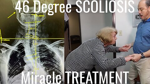 Knee Pain, Scoliosis & Can Not Walk treated by Chiropractor