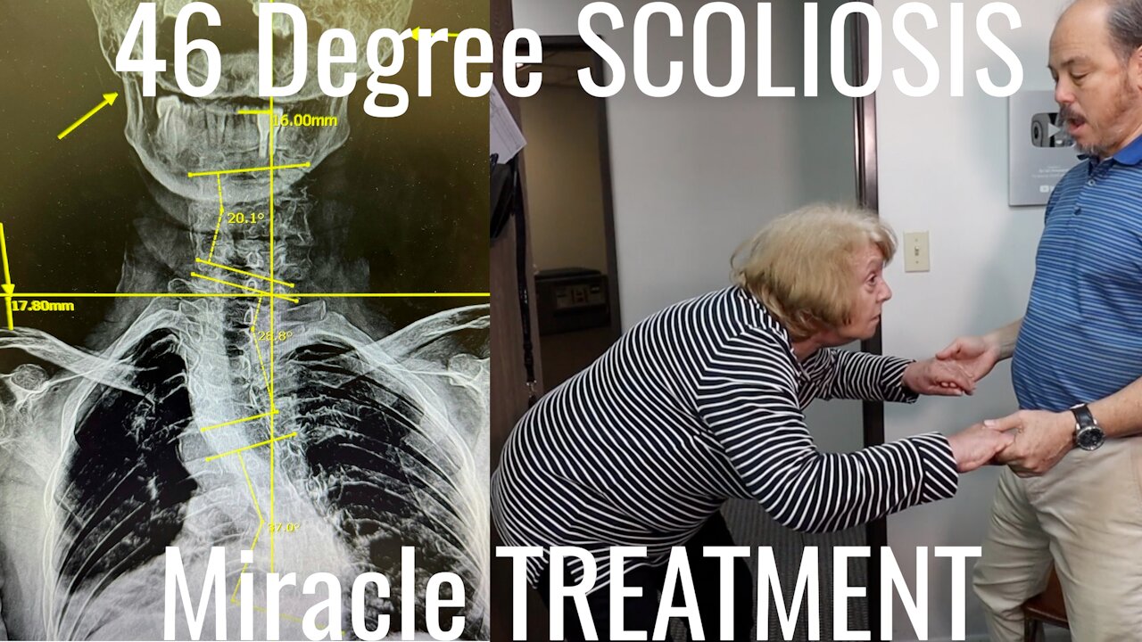 Knee Pain, Scoliosis & Can Not Walk treated by Chiropractor