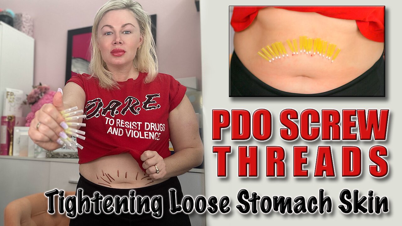 Tighten Loose Stomach Skin with PDO Screw Threads! AceCosm, Code Jessica10 Saves you Money