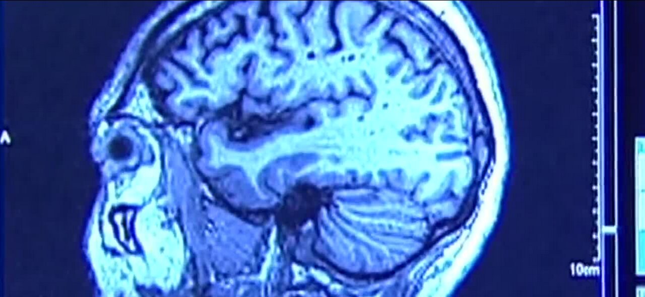 Doctors expand CTE common symptoms for diagnoses