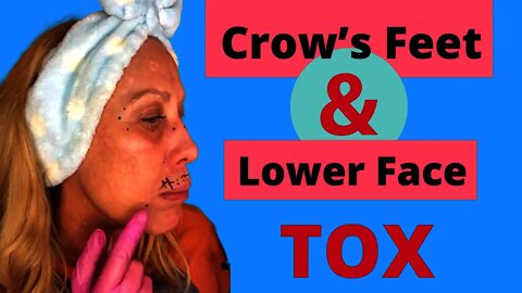 T0x Lower Face for Lift & How to Mark Crows Feet.