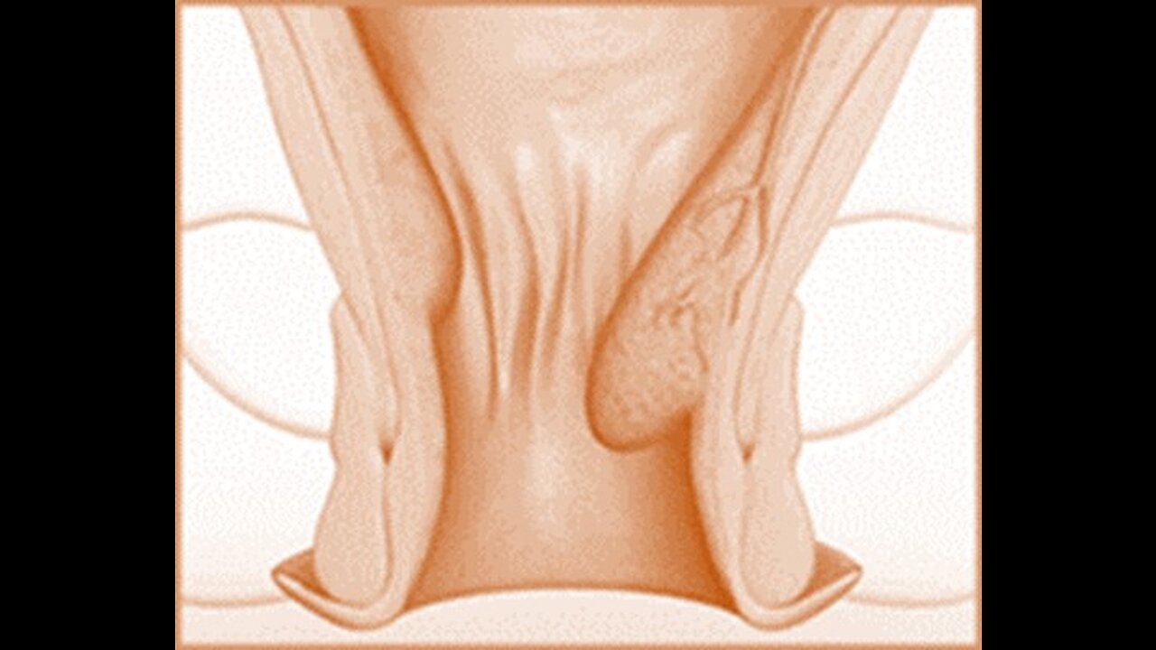 31. Hemorrhoids