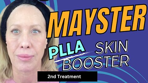 2nd Round Mayster Skin Booster with Before and 5 weeks Results