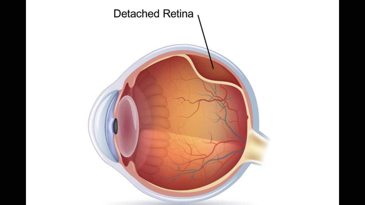 Detached Retina Dr Joel Wallach