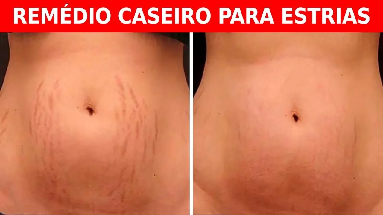 Faça as Estrias Desaparecer com estas Etapas Fáceis