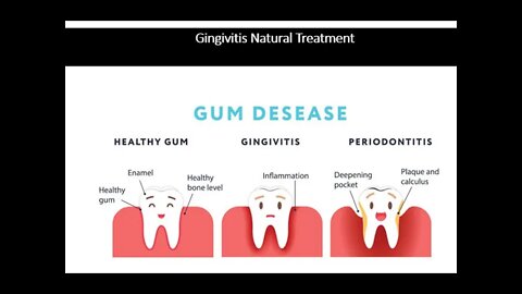 Gingivitis - Gum Inflammation & Infection - Natural Treatment