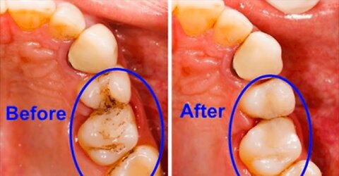 Get Rid of Cavities and Bad Breath and Bleeding Gums