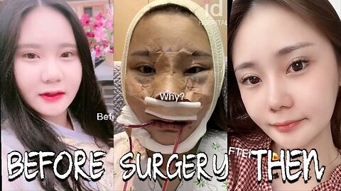 Shocking Plastic Surgery Transformation in Korea