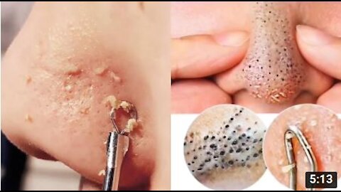 My Favorite Squeezes: Dr Pimple Popper