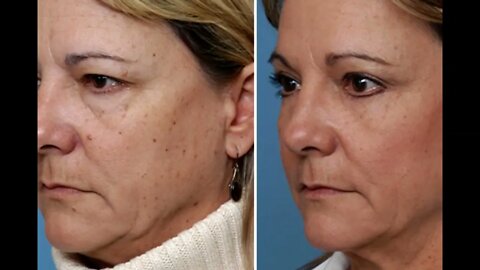 XanthRemover 70% Glycolic Acid Peel for Skin Tightening and other Aesthetic Applications