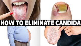 NEVER Get Candida Again