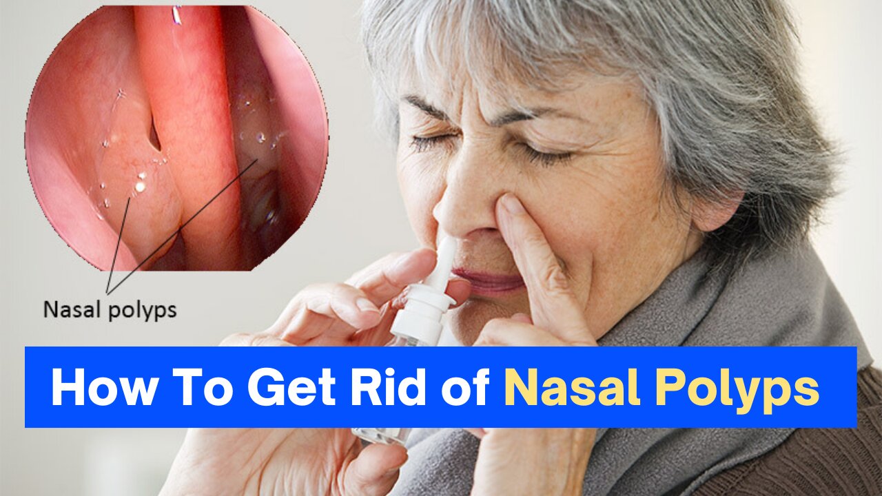 How To Get Rid of Nasal Polyps