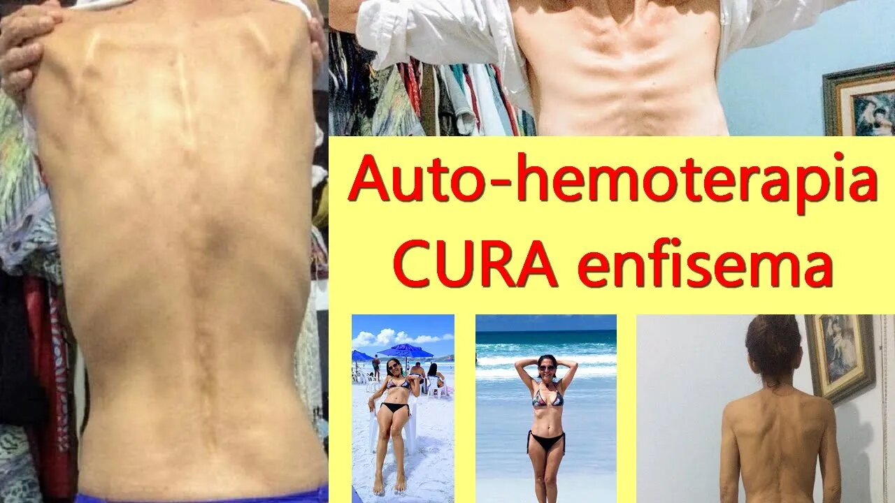 AUTO-HEMOTERAPIA CURA ENFISEMA. Relato de caso com registro fotográfico