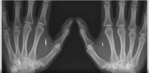 Greg Reese Banking Insider Warns CBDCs Will Be Implanted Chips
