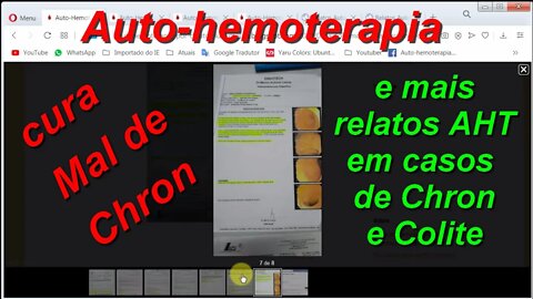 AUTO-HEMOTERAPIA CURA MAL DE CROHN. E TAMBÉM MAIS RELATOS AHT EM CASOS DE COLITE.