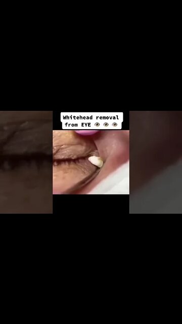 Must be very precise !! Whitehead Removal from Eye