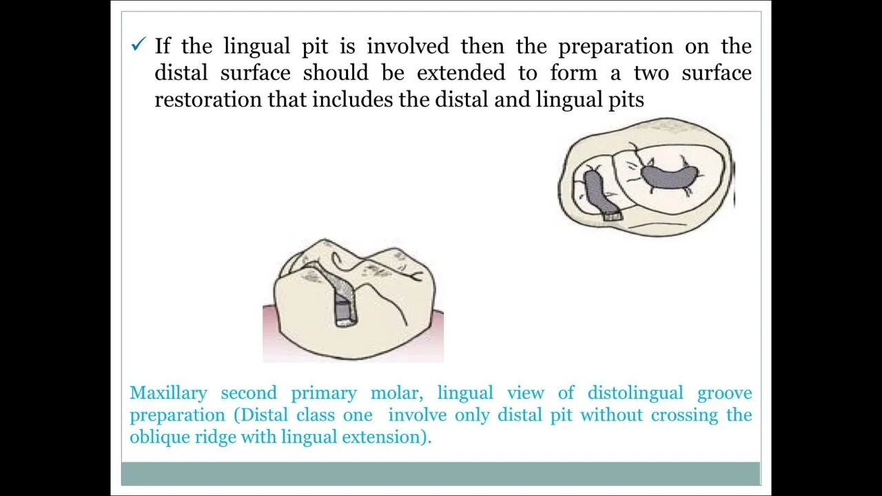 Pedodontics L11 (Morphology of Primary Posterior Teeth)