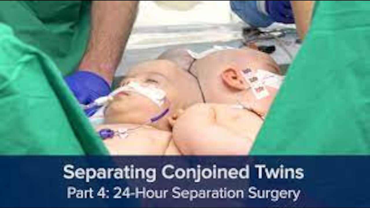 Separating Conjoined Twins Part 4 - 24-Hour Separation Surgery (surgery images blurred)