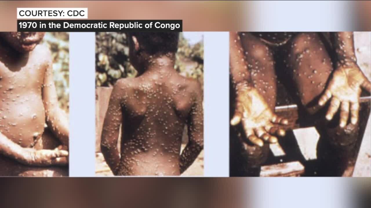 What is Monkeypox?