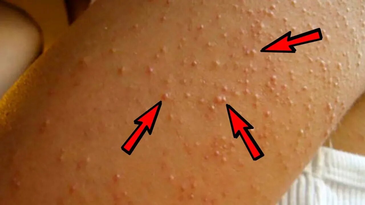 Natural Treatment to Get Rid of Keratosis Pilaris (Chicken Skin)