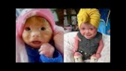 After Mom’s Emergency C Section Baby’s Skin Became Rock Hard And Began To Crack