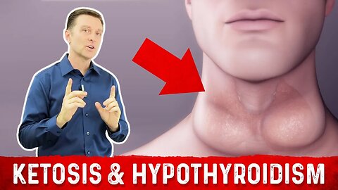 Does Ketosis Cause Hypothyroidism? – Dr.Berg