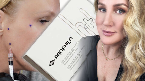 DIY Profhilo Using the BAP Technique | Facial Rejuvenation