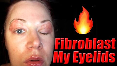 DIY Fibroblast My Eyelids | Code Jessica10 Saves you Money!