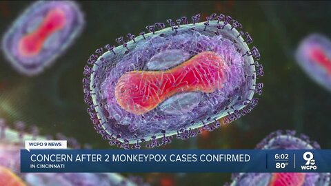 Monkeypox reported in Cincinnati, but doctor says not to hit panic button yet