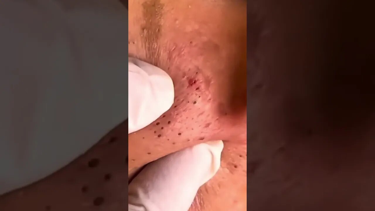 Remoção de Cravos e Espinhas - Remove Squeezing Blackheads and Pimples - Just Relax | Apenas Relaxe