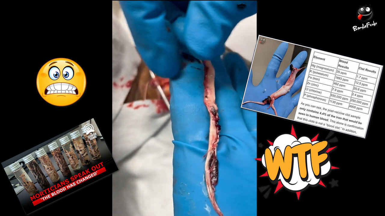 Graphic! Embalmer Removes White Fibrous Clots From Jugular Vein, Suggests C-VaxXxine Responsible