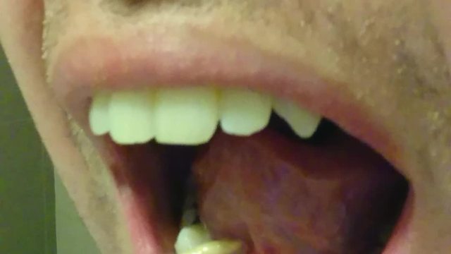 Salivary Stone Squeezed Out of Tongue